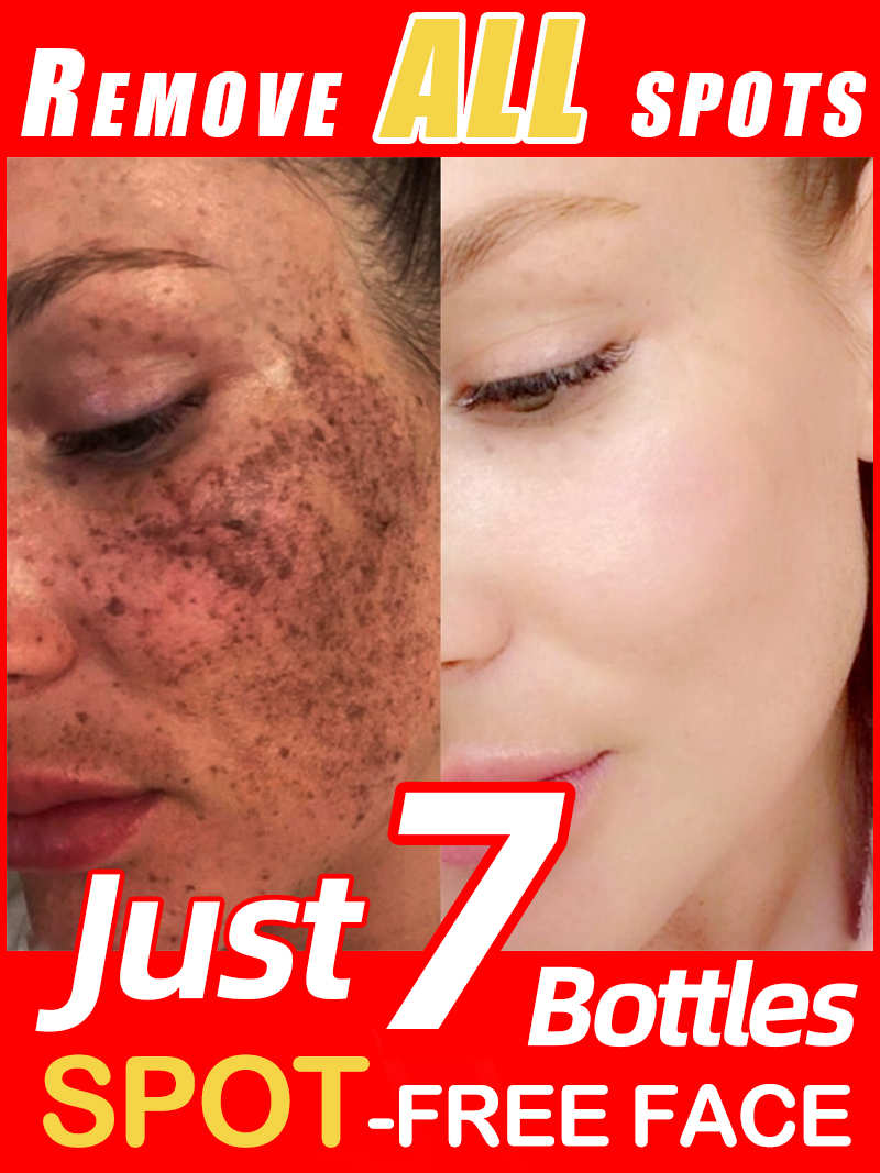 Ultra Luxury Skincare - Ilumine sardas melasma, manchas escuras faciais